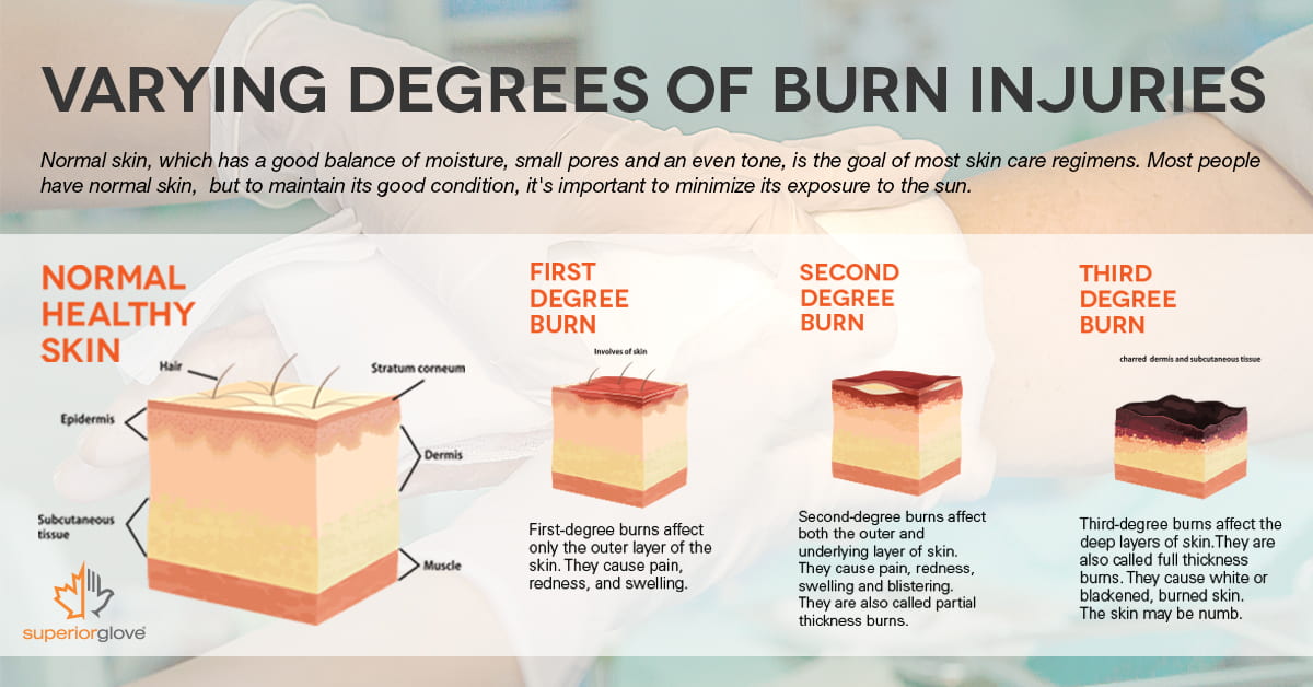 Burns effects