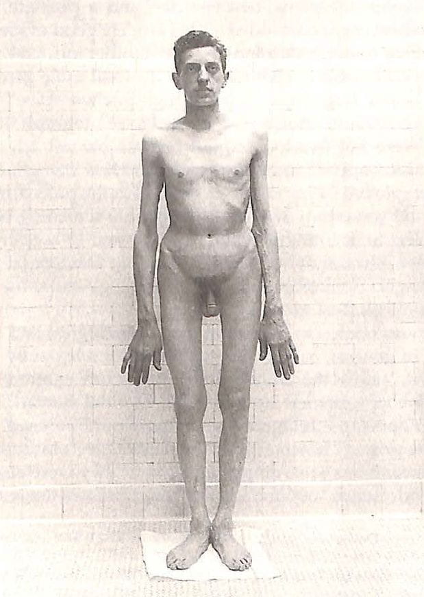 A grayscale photograph of a frontal nude male against a white wall, standing on a small towel. He gazes frontally, with upright slender shoulders, thin arms extended down on either side and palms facing the back wall. His waist narrows above broad hips, a defined pelvis, small triangle of pubic hair, thin thighs and calves, as he stands with splayed feet. As noted in the photograph title, he has no visible facial hair.