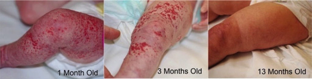 Hemangioma on legs of children