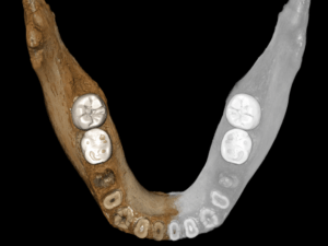 View of the virtual reconstruction of the Xiahe mandible