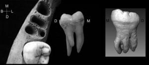 image of 3-rooted lower molar anomaly