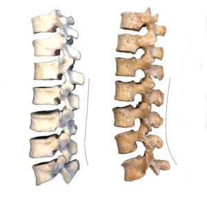 image comparing lower back bones of a modern human and neandertal