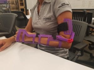 A purple 3D printed therapeutic split covering a persons upper arm, lower arm, and wrist. 